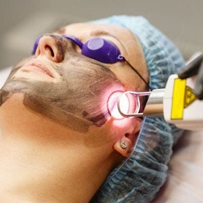 Laser Carbon Peel Treatment for Skin Fairness