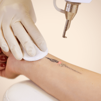 Laser Tattoo Removal for Dark Skin in Dubai & Abu Dhabi