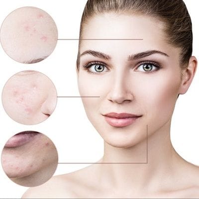 Subcision Treatment for Acne Scars Dubai & Abu Dhabi