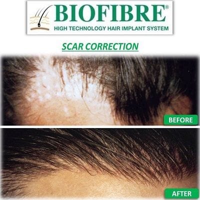 Biofibre Hair Implant Cost in Dubai