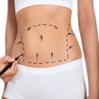 Mini Abdominoplasty in Dubai