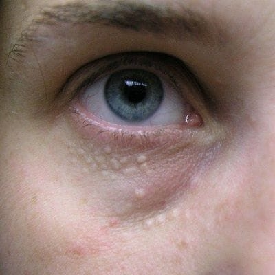 Syringoma Removal Treatment in Dubai & Abu Dhabi