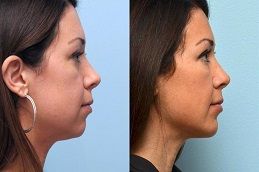 Chin Augmentation Treatment
