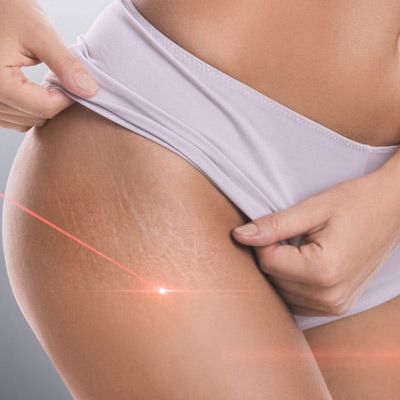 How Can You Get Rid of Stretch Marks