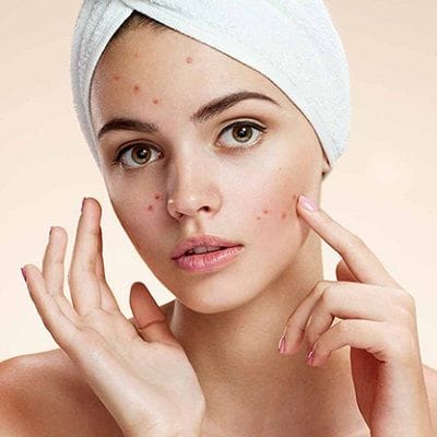 How to Remove Pimples Naturally and Permanently