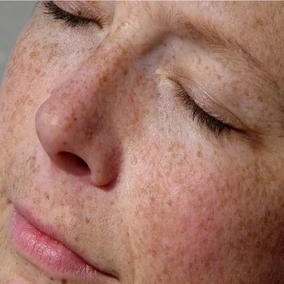 Dermal Pigmentation Treatment in Dubai