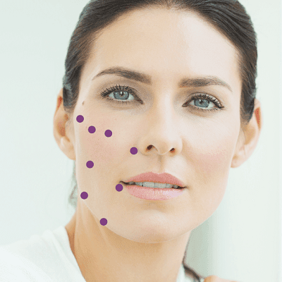8-point facelift with Juvederm in Dubai