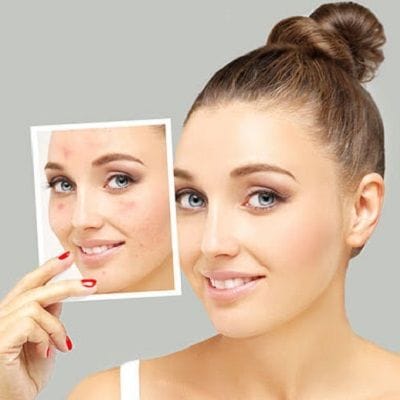 Fractional RF MicroNeedling Treatment in Dubai & Abu Dhabi - Dynamic Clinic