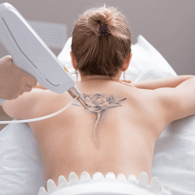 Laser Tattoo Removal Cost in Dubai