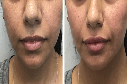 Lip Fillers Injections in dubai & abu dhabi