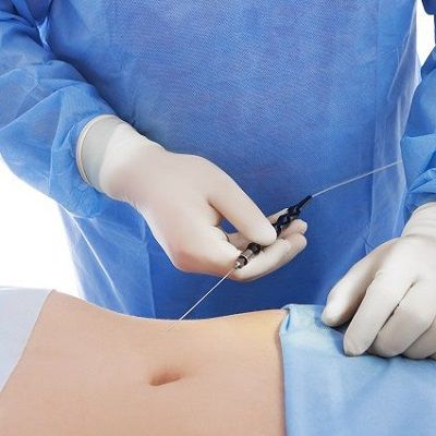 What Do You Know About GPS Laser Liposuction