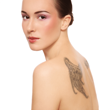 Laser Tattoo Removal for New Tattoo Dubai