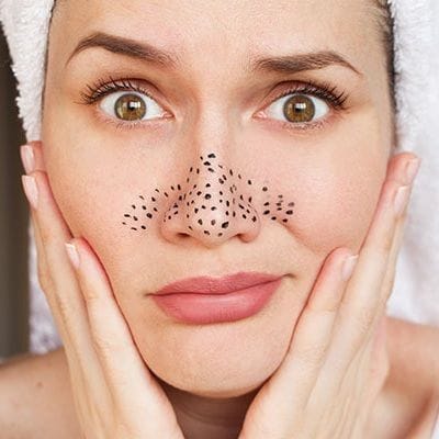 Blackheads Removal Treatment in Dubai & Abu Dhabi Dynamic Clinic