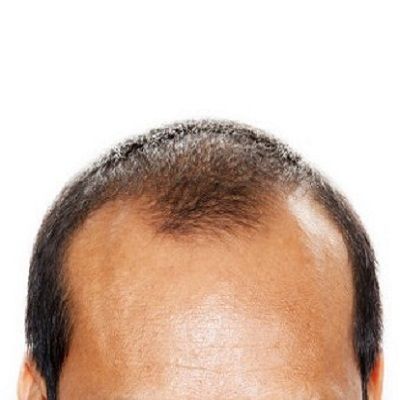 Hair Transplant for forehead reduction in Dubai