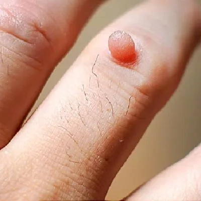 How To Remove Warts On Face in Dubai & Abu Dhabi Dynamic Clinic
