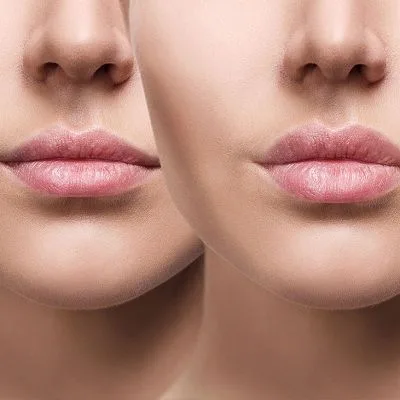 How to Make Lip Fillers Last Longer