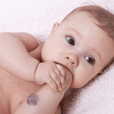 Is Laser Birthmark Removal Permanent