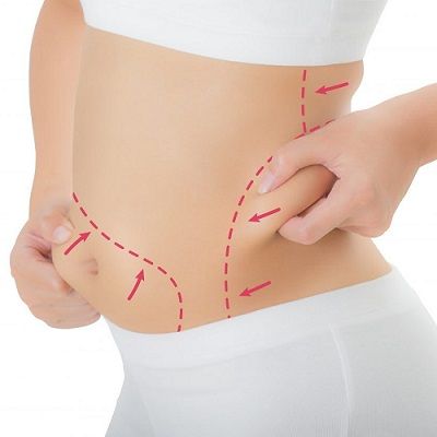 Non Invasive Liposuction in Dubai