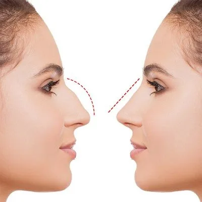 Non-Invasive Rhinoplasty Cost