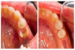 root-canal-treatment-cost-in-dubai