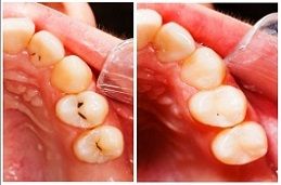 Teeth before and after treatment - dental composite filling.
