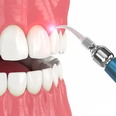 Gingivectomy Surgery in Dubai