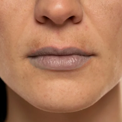 Laser Treatment for Dark Lips in dubai
