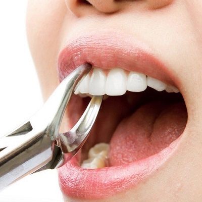 Tooth Extraction Cost in Dubai & Abu Dhabi