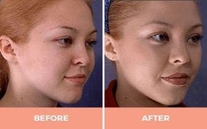 Ultrasonic Rhinoplasty Treatment