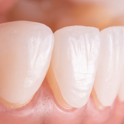 E-Max Veneers in Dubai & Abu Dhabi Porcelain Dental Veneers Cost