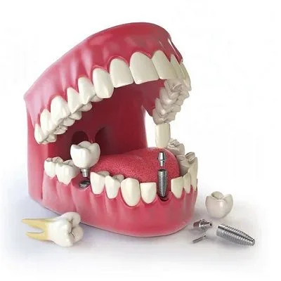 Best Dental Implants Cost