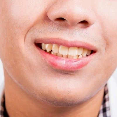Best Dental Stain Removal in Dubai & Abu Dhabi Dental Stains Cost