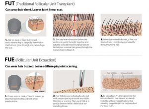 Best Hair Transplant Clinic in Dubai & Abu Dhabi