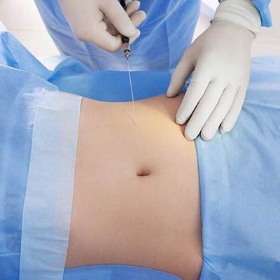 Best liposuction Surgery Clinic in Dubai