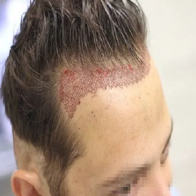 Cheap And Best Hair Transplant in Dubai, Abu Dhabi & Sharjah