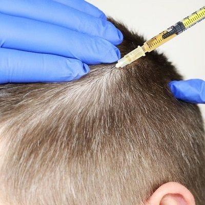 Cheapest Prp Treatment in Dubai, Abu Dhabi & Sharjah Cost