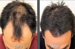 Cheapest prp Treatment in Dubai & Abu Dhabi