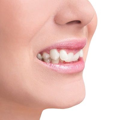 Crooked Teeth Treatment in Dubai