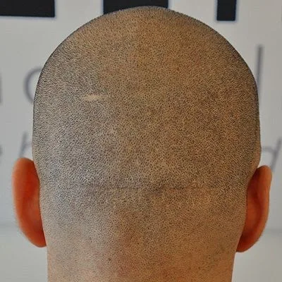 Do Hair Transplants Leave Scars