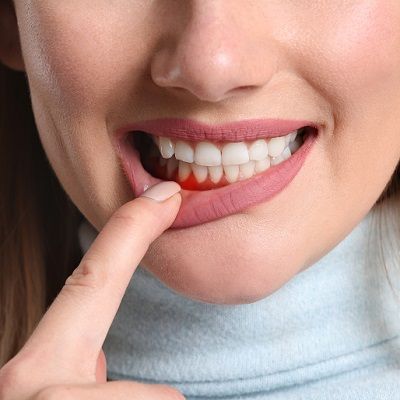 Gum Bleeding Treatment