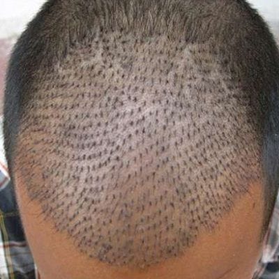 Hair Restoration Center in Dubai, Abu Dhabi & Sharjah Cost