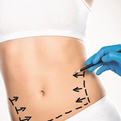 How Long Do the Effects of Liposuction Surgery Last