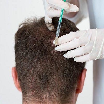 PRP Injections for Hair Loss in Dubai, Abu Dhabi & Sharjah