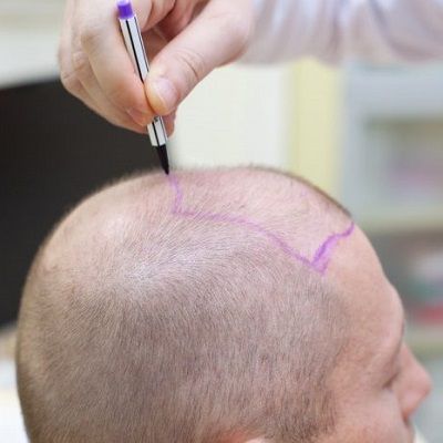 Why are Hair Transplants So Cheap in Dubai