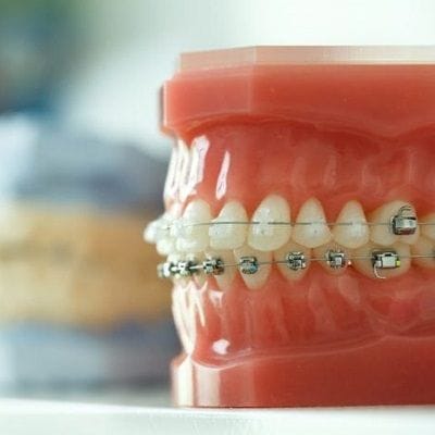 Best Dental Appliance in Dubai & Abu Dhabi Dental Appliance Cost