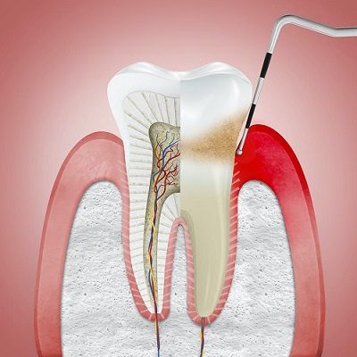 Best Gingivitis in Dubai & Abu Dhabi Gingivitis Cost & Price