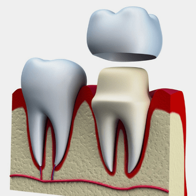 Crown After Root Canal Treatment in Dubai