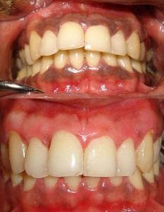 Gum Depigmentation in Dubai & Abu Dhabi UAE