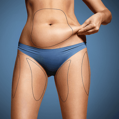 ¿Cuánto peso puede perder la liposucción? 1 ¿Cuánto peso puede perder la liposucción?