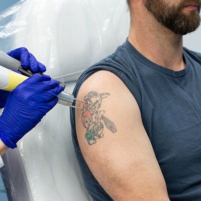 Laser Tattoo Removal for Blue Ink